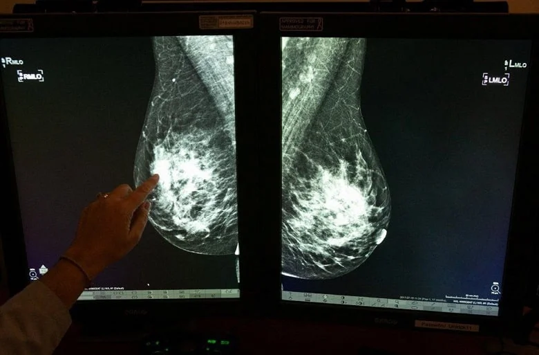 توده های بدخیم یا سرطانی در ماموگرافی سفید هستند