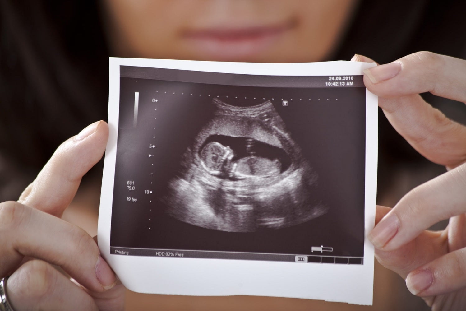 طول جنین در مرحله غربالگری اول