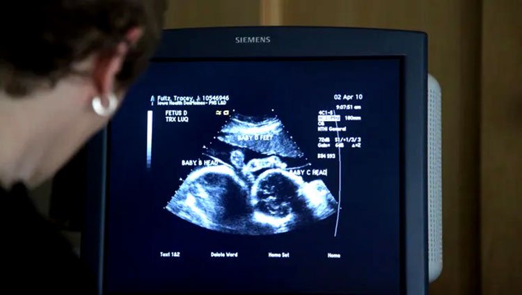 tcd در سونوگرافی جنین چیست