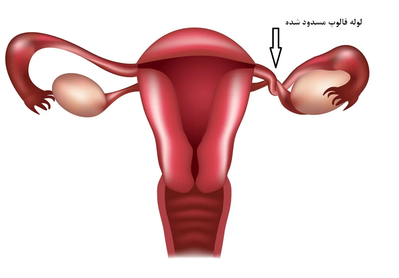 مشاهده لوله فالوپ مسدود شده در عکس رنگی رحم