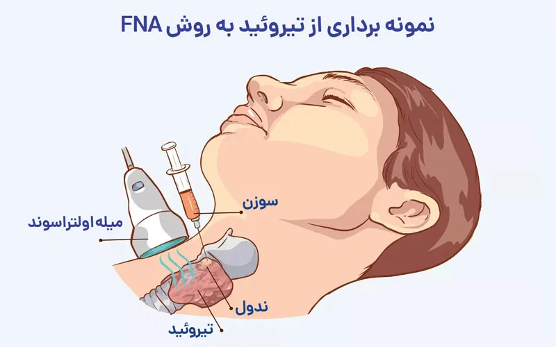 روش نمونه برداری fna