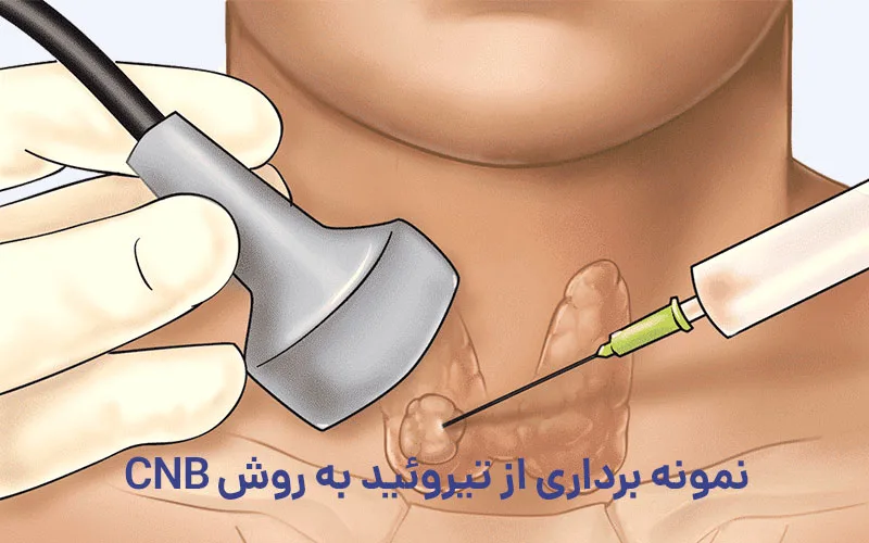 نمونه برداری سوزنی هسته ای یا CNB